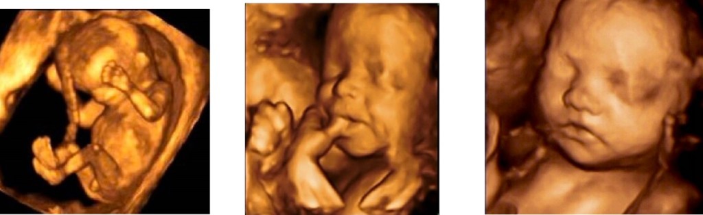 3d-ultrasounds-a-storks-view