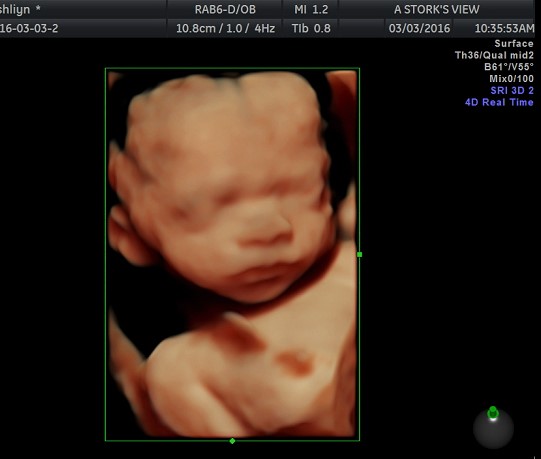 HD Ultrasound live sonogram picture